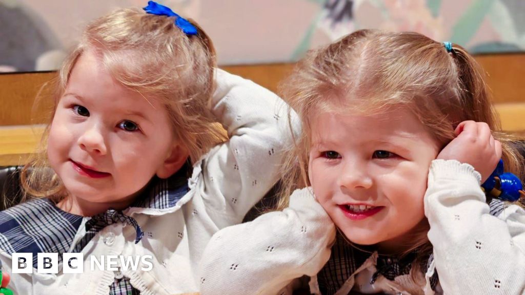Pioneering treatment saves identical twins from rare pregnancy condition Pioneering treatment saves identical twins from rare pregnancy condition