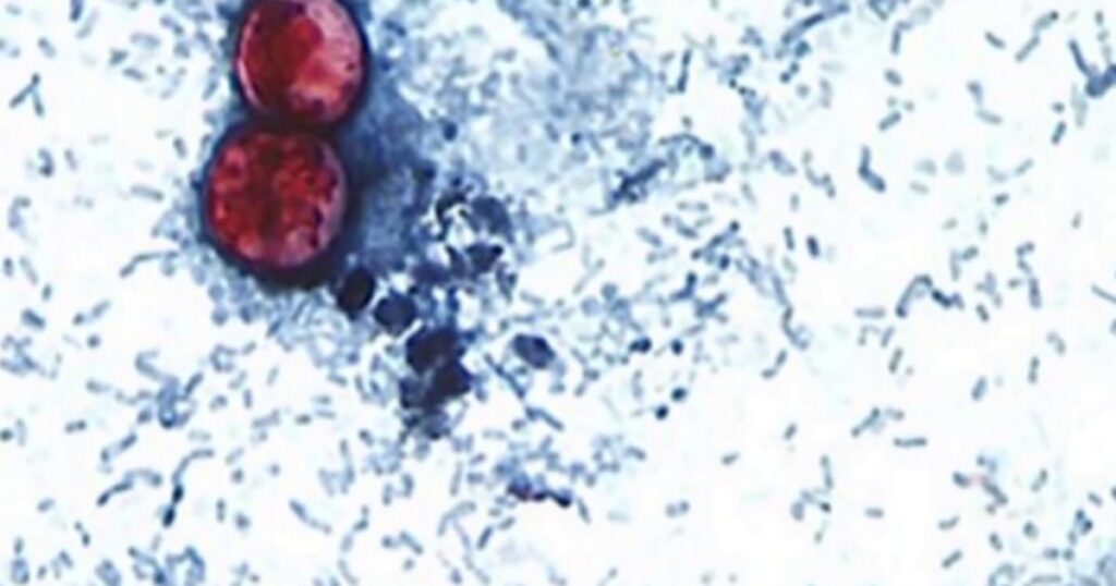 Cases of illness that causes explosive diarrhea on the rise across the U.S. Cases of illness that causes explosive diarrhea on the rise across the U.S.