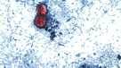 ‘Explosive diarrhea’ parasite on the rise in U.S., reported in 17 states