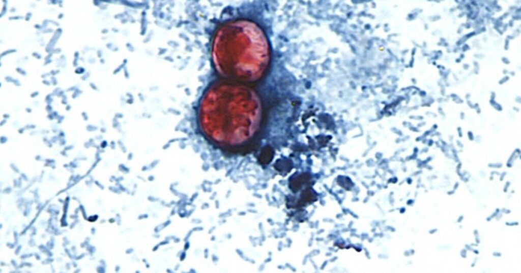 Cyclosporiasis cases in Florida nearly double in a week, but that could be a undercount Cyclosporiasis cases in Florida nearly double in a week, but that could be a undercount