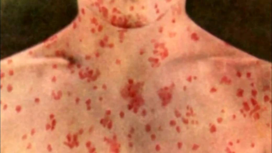 Click to play video: 'Questions raised over measles town hall'