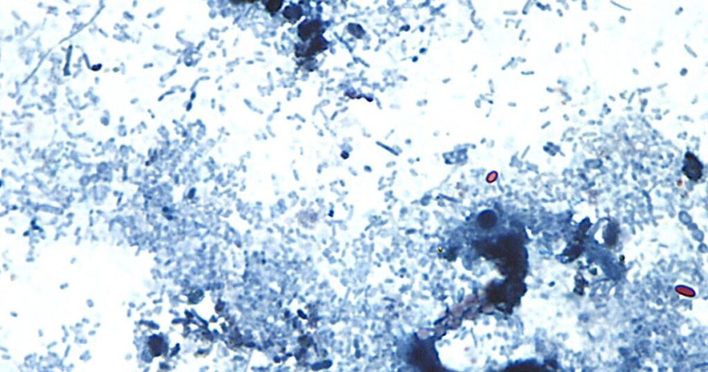 Does cooking or vinegar kill Cyclospora? How to avoid the diarrhea-causing parasite, according to health officials