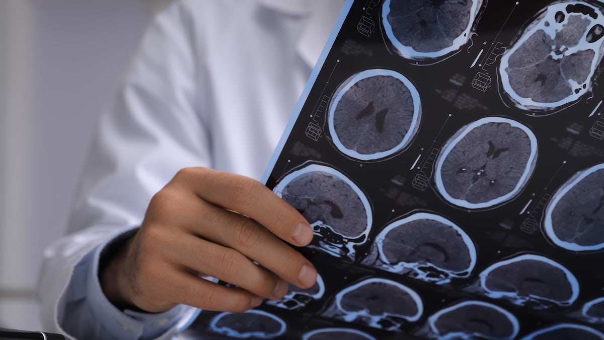 doctor holds up brain scan