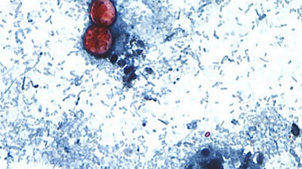 Why the 2026 cyclosporiasis outbreak is worse than previous years Why the 2026 cyclosporiasis outbreak is worse than previous years