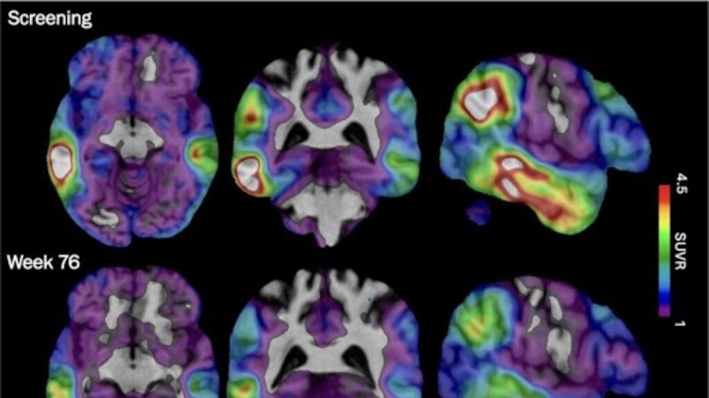 Experimental Alzheimer’s drug shows some promise as researchers hunt new approaches Experimental Alzheimer's drug shows some promise as researchers hunt new approaches