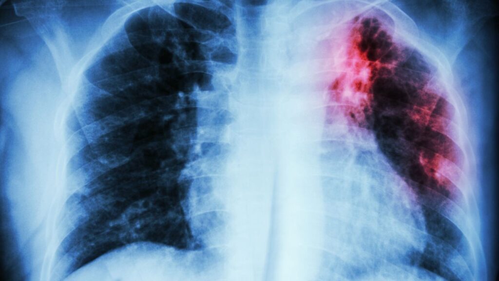 State health officials probe tuberculosis exposure at Summerville High School