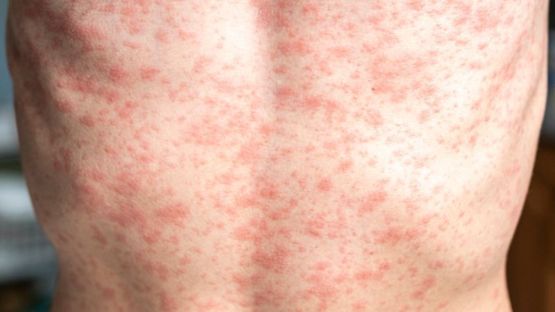 FILE - A person with a rash or measles.{ } (Photo: AdobeStock)