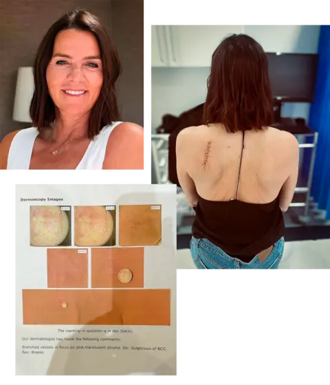 Annabel Annabel, her scans and picture of the post op scar on her back