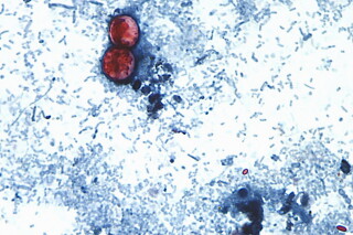 This undated photo taken through a microscope provided by the CDC shows Cyclospora cayetanensis oocysts found in a fresh stool sample which had been prepared with a formalin solution and stained with safranin. (CDC via AP, File)