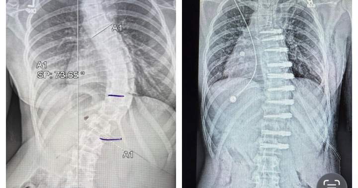 Alberta teen’s family sues government after nearly $200K out-of-country surgical bill Alberta teen’s family sues government after nearly $200K out-of-country surgical bill