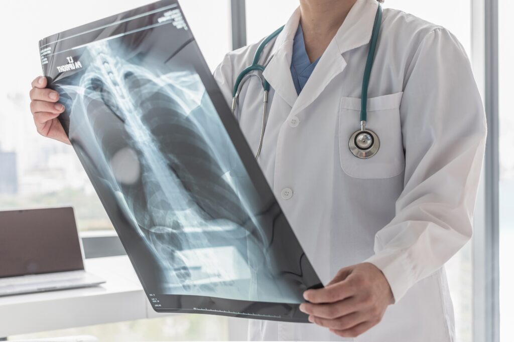Years After He Quit Smoking, a Lung Cancer Scan Saved His Life