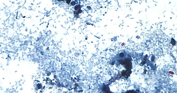 Cyclospora outbreak tied to lettuce now linked to 15 states: reports – National Cyclospora outbreak tied to lettuce now linked to 15 states: reports - National